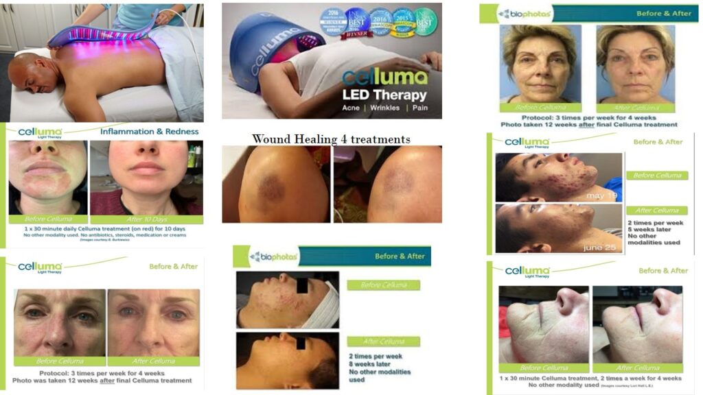 LED Light Therapy San Antonio — Celluma treatment at Lavender Falls Face and Body Spa